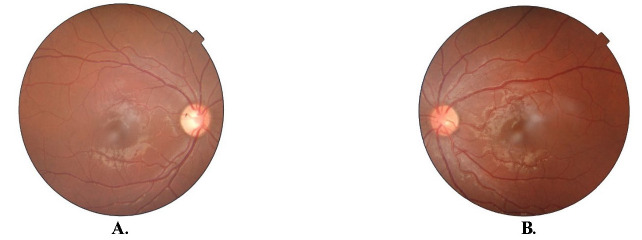 Atypical Presentation of Foster Kennedy Syndrome due to Neurocysticercosis: A Rare Case Report.