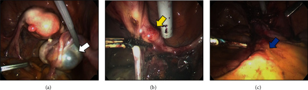 A Case Report of Occult Breast Cancer Detected by Diagnostic Laparoscopy for Suspected Ovarian Cancer.
