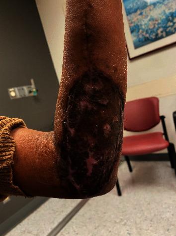 The Role of Surgery to Relieve Symptomatic Cutaneous T-Cell Lymphoma Refractory to Medical Treatments.