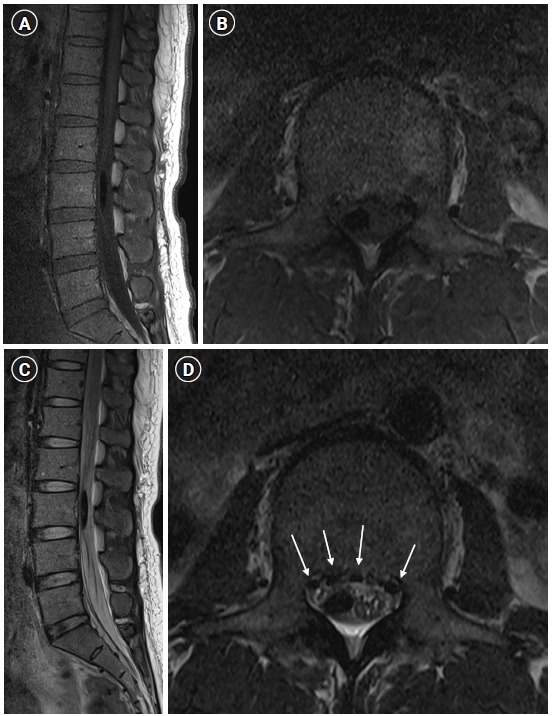 Unintended subdural anesthesia and subdural air bubbles after attempted epidural anesthesia in a patient undergoing cesarean section.
