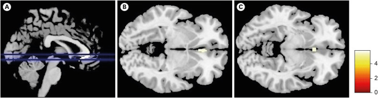 Ventral Anterior Cingulate Atrophy as a Predisposing Factor for Transient Global Amnesia.