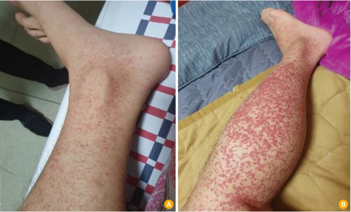 Henoch-Schönlein purpura following mRNA COVID-19 vaccination: a case report.