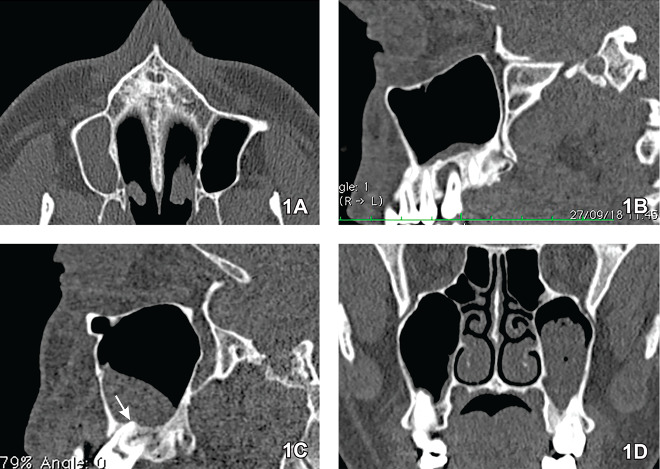 Relationship between periapical lesions and sinus changes on multi-slice computed tomography sean.