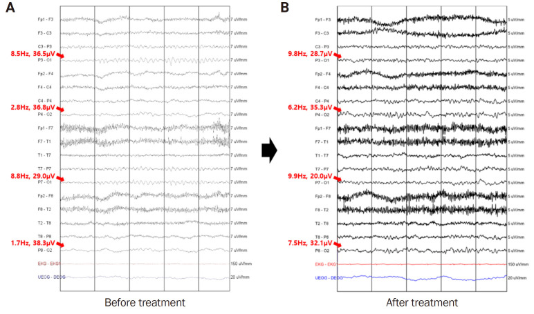 Myelin oligodendrocyte glycoprotein antibody-associated disease presenting as unilateral cerebral cortical encephalitis: a case report.