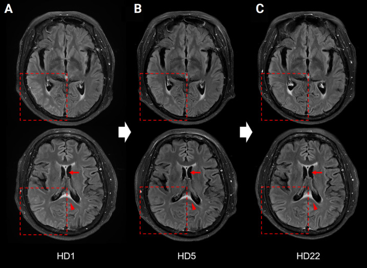 Myelin oligodendrocyte glycoprotein antibody-associated disease presenting as unilateral cerebral cortical encephalitis: a case report.
