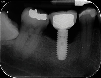 The Morphology of Peri-Implantitis Bone Defects: A Retrospective Study on Periapical Radiographs.