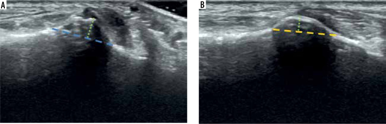 Ultrasound measurements of the normal peroneal tubercle: validation of the normal anatomical measurements and evaluation of the intra- and interobserver reliability.