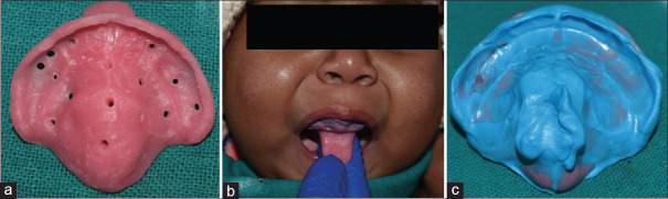 Rehabilitation Using Hybrid Technique for Feeding Plate Fabrication in a 3-Month-Old Infant with Cleft Palate Defect Utilising Digital and Conventional Method: A Case Report.