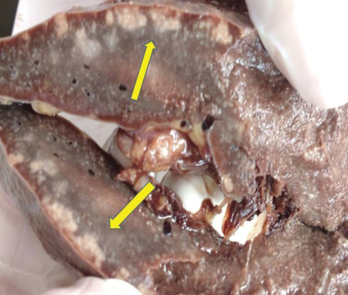 A Rare Co-existent Case of Splenic Microfilariasis and Pancreatic Solid Pseudopapillary Epithelial Neoplasm - A Double Jeopardy!