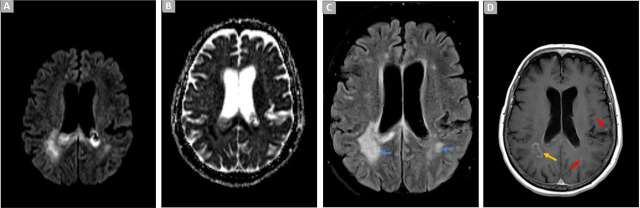 Cefiderocol and Intraventricular Colistin for Ventriculitis due to an Extensively Drug-Resistant <i>Pseudomonas Aeruginosa</i>.