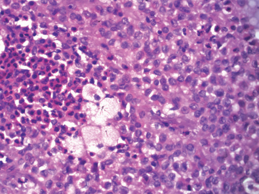 A Rare Co-existent Case of Splenic Microfilariasis and Pancreatic Solid Pseudopapillary Epithelial Neoplasm - A Double Jeopardy!