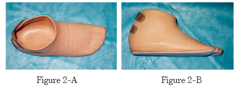 Investigation of walking speed and plantar pressure after chopart amputation.
