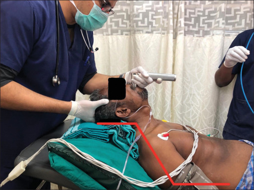 Bed-up-head-elevated Position versus Supine Sniffing Position in Patients Undergoing Rapid Sequence Intubation Using Direct Laryngoscopy in the Emergency Department - A Randomized Controlled Trial.