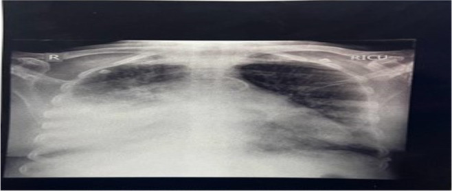 Ruptured Lung Hydatid Cyst Masquerading as a Transudative Parapneumonic Effusion: A Case Report.