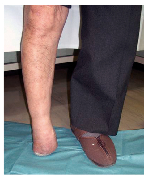 Investigation of walking speed and plantar pressure after chopart amputation.