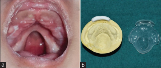 Rehabilitation Using Hybrid Technique for Feeding Plate Fabrication in a 3-Month-Old Infant with Cleft Palate Defect Utilising Digital and Conventional Method: A Case Report.