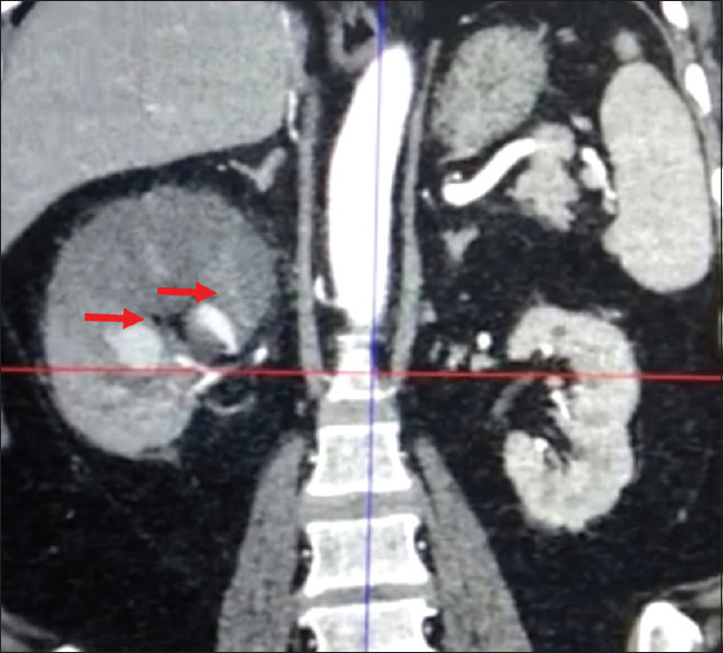Renal artery pseudoaneurysm post-COVID-19 infection: An unusual delayed complication.