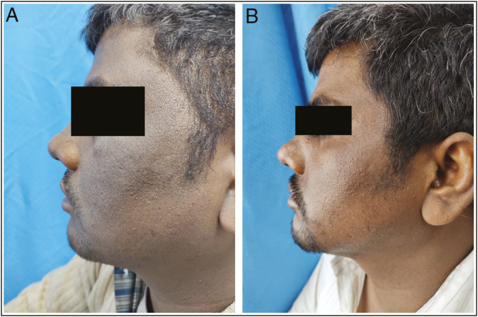 Efficacy of 15% trichloroacetic acid peel versus 35% glycolic acid peel in acanthosis Nigricans: A randomized open-label study.