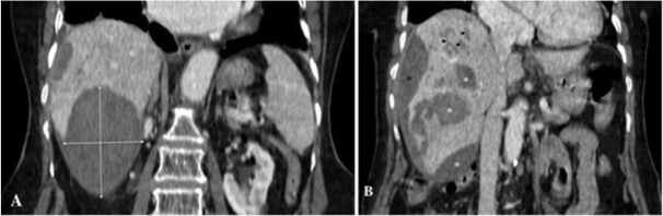 The Hepatic Phase of Fascioliasis Complicated with Liver Bleeding: Presentation of Three Cases.