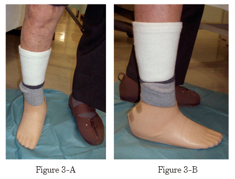 Investigation of walking speed and plantar pressure after chopart amputation.
