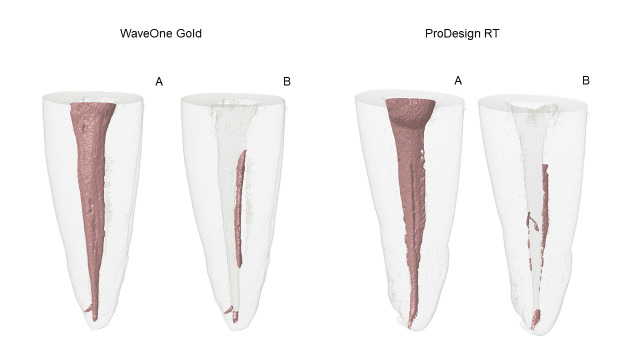 Efficacy of WaveOne Gold and ProDesign RT systems in removing filling material: a micro-CT analysis.