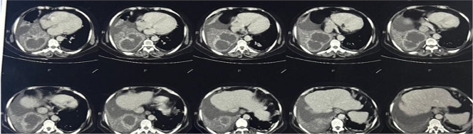 Ruptured Lung Hydatid Cyst Masquerading as a Transudative Parapneumonic Effusion: A Case Report.