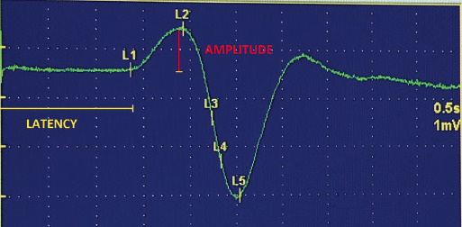 Autonomic Dysfunction in Amyotrophic Lateral Sclerosis - A Case-Control Study.