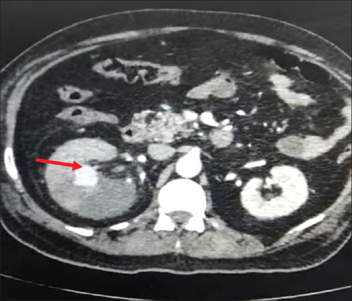 Renal artery pseudoaneurysm post-COVID-19 infection: An unusual delayed complication.