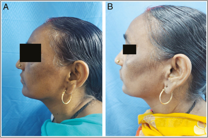 Efficacy of 15% trichloroacetic acid peel versus 35% glycolic acid peel in acanthosis Nigricans: A randomized open-label study.