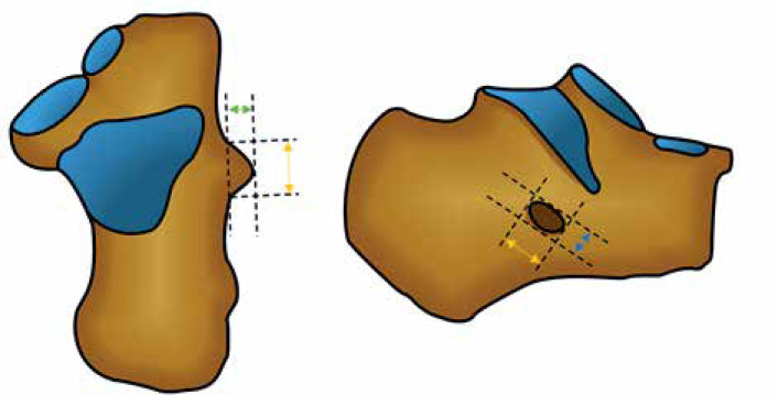 Ultrasound measurements of the normal peroneal tubercle: validation of the normal anatomical measurements and evaluation of the intra- and interobserver reliability.