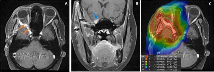Long-Term Outcomes Following Definitive or Adjuvant Proton Radiotherapy for Adenoid Cystic Carcinoma.