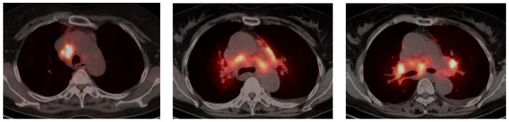 Diagnostic Value of Imaging and Serological Biomarkers in Pulmonary Sarcoidosis.