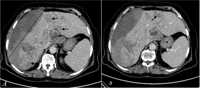 The Hepatic Phase of Fascioliasis Complicated with Liver Bleeding: Presentation of Three Cases.