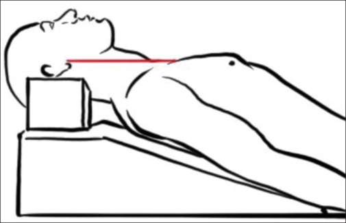 Bed-up-head-elevated Position versus Supine Sniffing Position in Patients Undergoing Rapid Sequence Intubation Using Direct Laryngoscopy in the Emergency Department - A Randomized Controlled Trial.