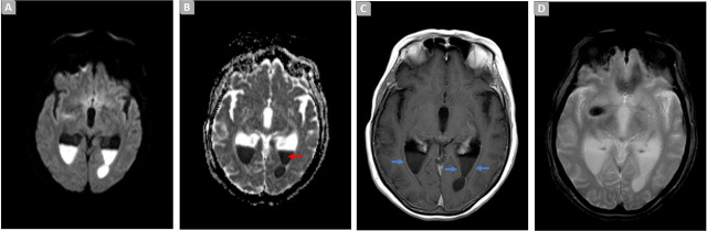 Cefiderocol and Intraventricular Colistin for Ventriculitis due to an Extensively Drug-Resistant <i>Pseudomonas Aeruginosa</i>.