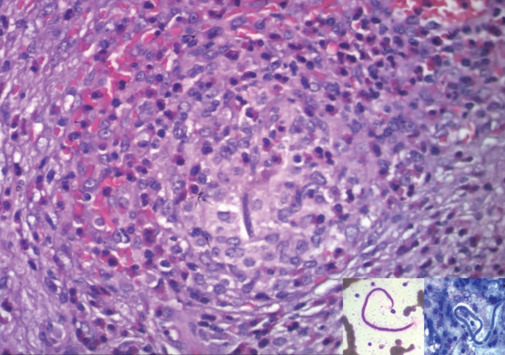 A Rare Co-existent Case of Splenic Microfilariasis and Pancreatic Solid Pseudopapillary Epithelial Neoplasm - A Double Jeopardy!