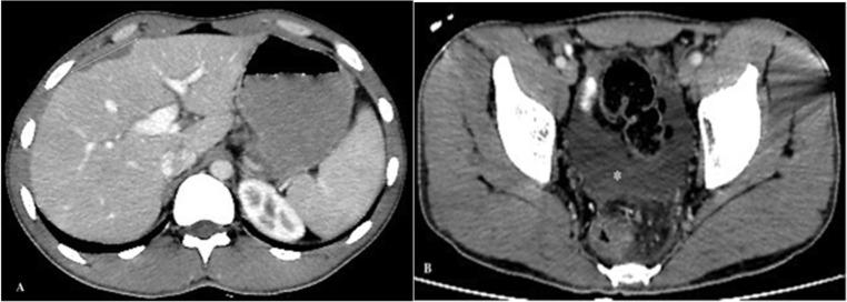 The Hepatic Phase of Fascioliasis Complicated with Liver Bleeding: Presentation of Three Cases.