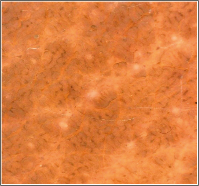 Efficacy of 15% trichloroacetic acid peel versus 35% glycolic acid peel in acanthosis Nigricans: A randomized open-label study.