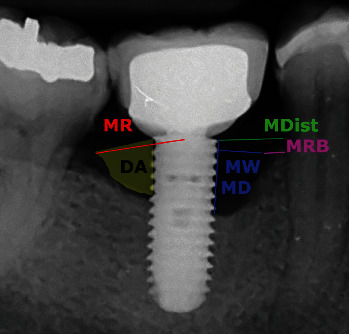 The Morphology of Peri-Implantitis Bone Defects: A Retrospective Study on Periapical Radiographs.