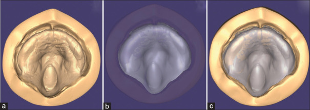 Rehabilitation Using Hybrid Technique for Feeding Plate Fabrication in a 3-Month-Old Infant with Cleft Palate Defect Utilising Digital and Conventional Method: A Case Report.