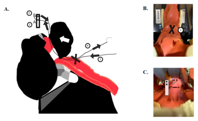 Modification of an Airway Training Mannequin to Teach Engagement of the Hyoepiglottic Ligament.