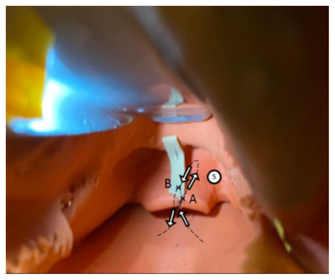 Modification of an Airway Training Mannequin to Teach Engagement of the Hyoepiglottic Ligament.