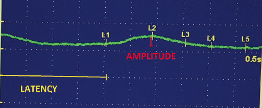 Autonomic Dysfunction in Amyotrophic Lateral Sclerosis - A Case-Control Study.