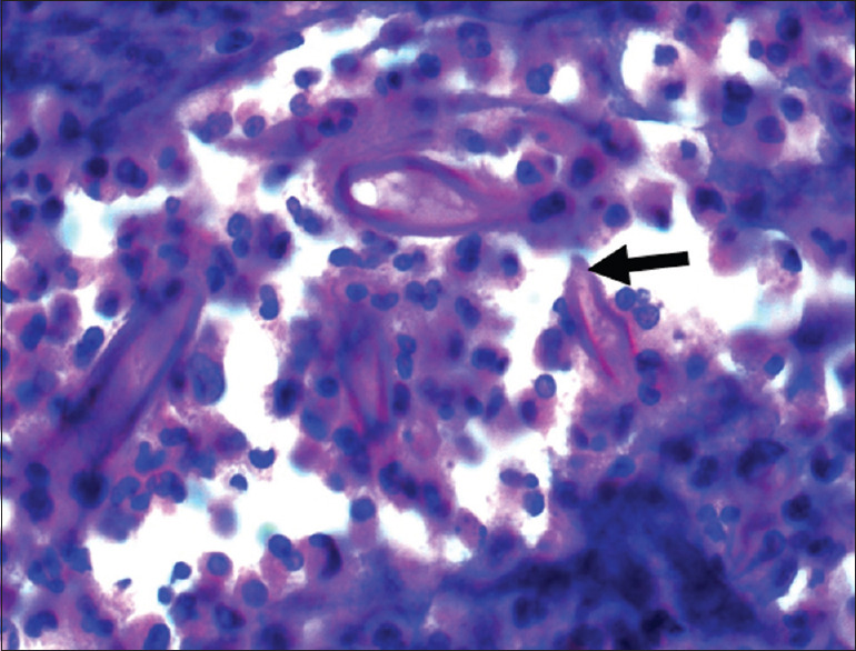 Renal artery pseudoaneurysm post-COVID-19 infection: An unusual delayed complication.