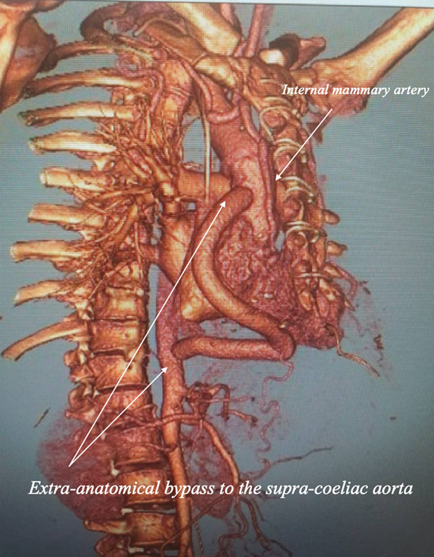 Dieulafoy's Lesion: A Rare Cause of Gastrointestinal Bleeding after Interrupted Aortic Arch Repair in an Adult.