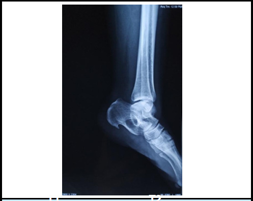 Intraosseous Lipoma of Calcaneus An Uncommon Cause of Heel Pain: A Case Report.