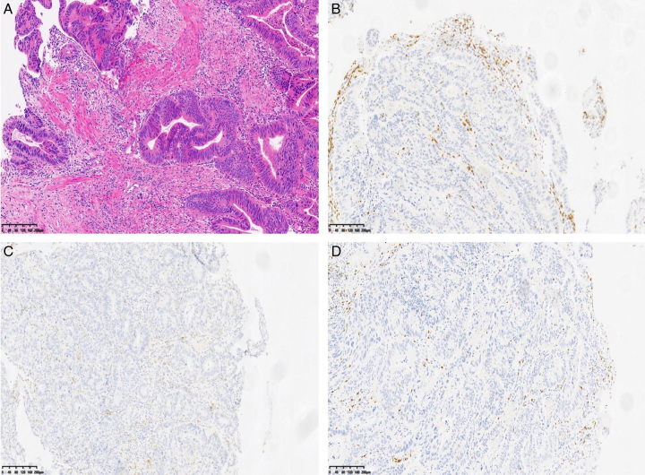 Pathologic Complete Response After Gastric Artery Chemoembolization Combined With Tislelizumab for Neoadjuvant Therapy of Locally Advanced Gastric Cancer: A Case Report.