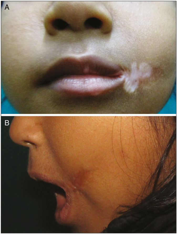 Successful management of an unusual hypopigmented scar after surgical repair of a unilateral Tessier 7 cleft.