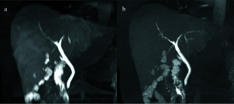 Breath-hold High-resolution T1-weighted Gradient Echo Liver MR Imaging with Compressed Sensing Obtained during the Gadoxetic Acid-enhanced Hepatobiliary Phase: Image Quality and Lesion Visibility Compared with a Standard T1-weighted Sequence.