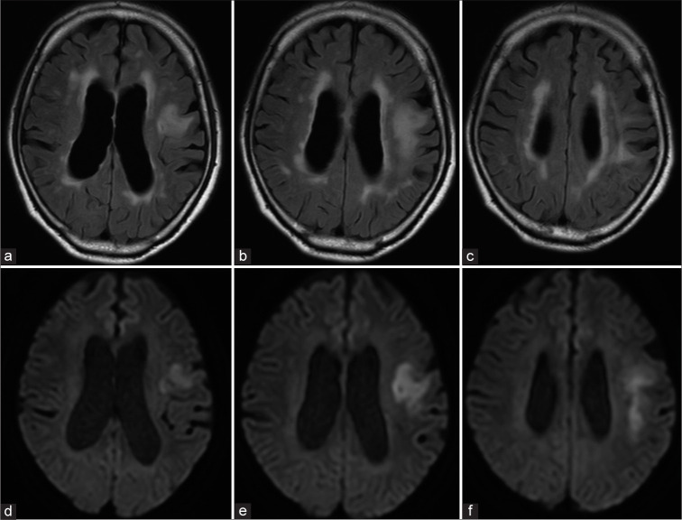 Progressive multifocal leukoencephalopathy associated with rituximab treatment.